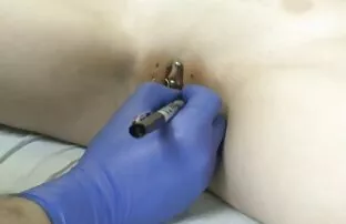 కుట్లు 1