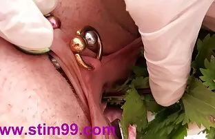 తేలు తేలు మరియు వల్వాలో యురేత్రల్ అనస్టోమోసిస్